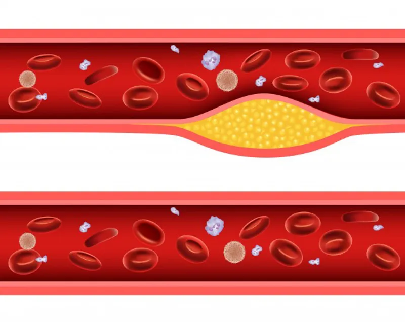 Diabetes and Cholesterol