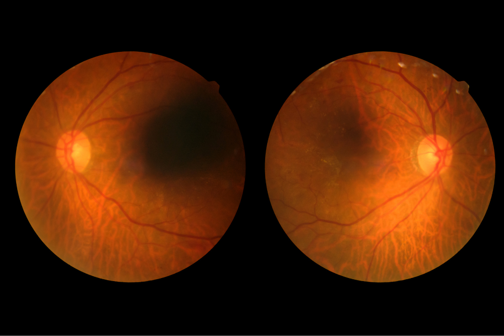 Image for Closer monitoring and treatment of diabetic retinopathy